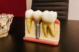 A colocação de implantes dentários é sem dúvida a solução mais eficaz para os pacientes que pretendem substituir um, vários ou todos os dentes perdidos